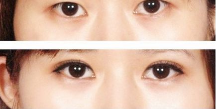 超 声 波双眼 皮效果好不好?案例在这里! 超 声 波双眼 皮效果好不好?案例在这里!