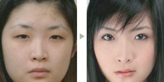 超 声 波双眼 皮效果好不好?案例在这里! 超 声 波双眼 皮效果好不好?案例在这里!