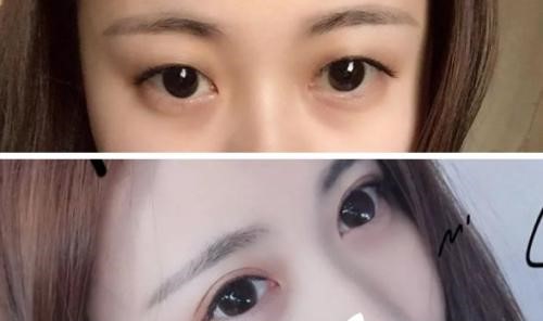 超声波双眼皮效果眼型自然076 超声波双眼皮效果眼型自然076