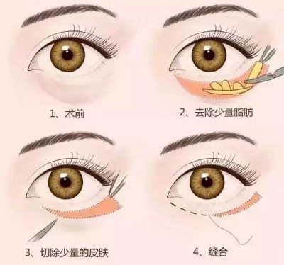 超声波去眼袋,一次性扫除的最佳方法361 超声波去眼袋,一次性扫除的最佳方法361