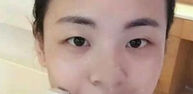 国庆找重庆超雅梁医生做了超声波双眼皮479 国庆找重庆超雅梁医生做了超声波双眼皮479