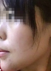 不开刀下巴延长术真人记录 不开刀下巴延长术真人记录