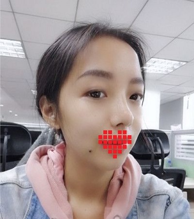 做个超声波去眼袋,真的是标准的美人脸865 做个超声波去眼袋,真的是标准的美人脸865
