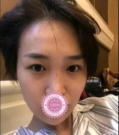 成功获得双眼皮经历201 成功获得双眼皮经历201