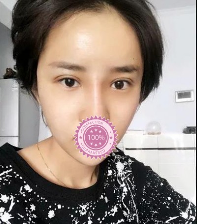 成功获得双眼皮经历201 成功获得双眼皮经历201