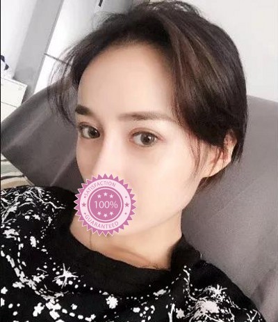 成功获得双眼皮经历201 成功获得双眼皮经历201
