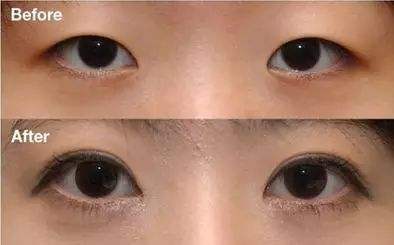 超声 波双yǎn皮