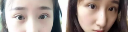 超声波双眼皮5天，还不太自然，着急分享给大家看！731