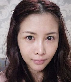 长效玻尿酸填充泪沟,效果真得很好! 长效玻尿酸填充泪沟,效果真得很好!