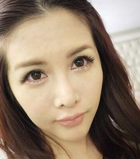 长效玻尿酸填充泪沟,效果真得很好! 长效玻尿酸填充泪沟,效果真得很好!