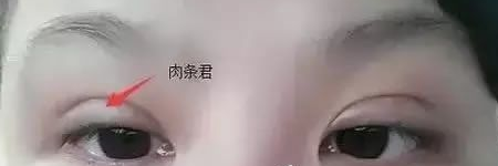 做完双眼 皮手术后为什么会有肉条呢? 做完双眼 皮手术后为什么会有肉条呢?