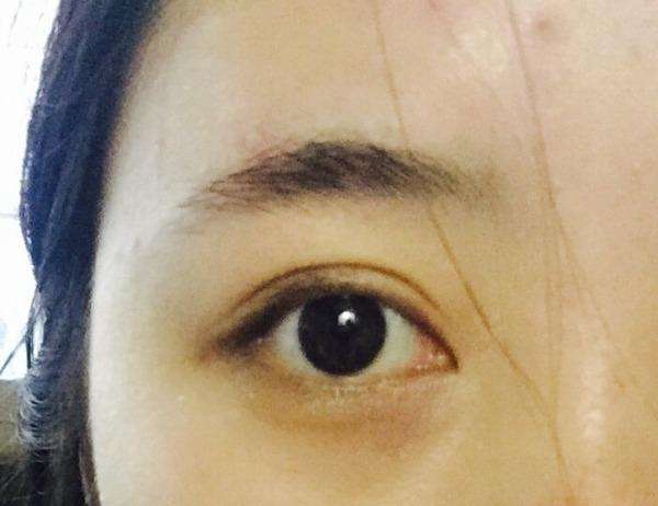 做完双眼 皮手术后为什么会有肉条呢? 做完双眼 皮手术后为什么会有肉条呢?