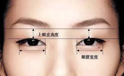 做完双眼 皮手术后为什么会有肉条呢? 做完双眼 皮手术后为什么会有肉条呢?