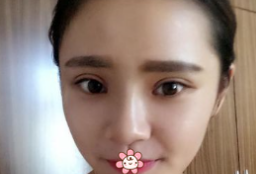 超声波双眼皮技术怎么样?女汉子来见证啦!324 超声波双眼皮技术怎么样?女汉子来见证啦!324