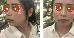 不开刀下巴延长术在重庆超雅做的效果如何呢?583 不开刀下巴延长术在重庆超雅做的效果如何呢?583
