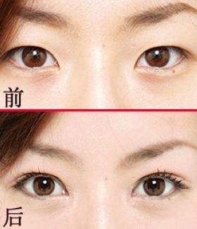 眼皮比较厚适合什么类型的双眼皮手术?918 眼皮比较厚适合什么类型的双眼皮手术?918