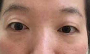 超声波双眼皮真实案例,图片证明效果!117 超声波双眼皮真实案例,图片证明效果!117