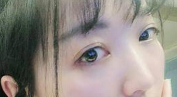 超声波双眼皮真实案例,图片证明效果!117 超声波双眼皮真实案例,图片证明效果!117