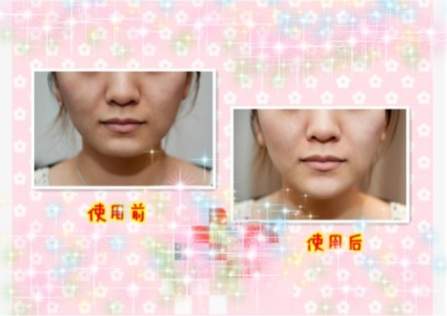 重庆超雅不开刀下巴延长术有哪些特色?349 重庆超雅不开刀下巴延长术有哪些特色?349