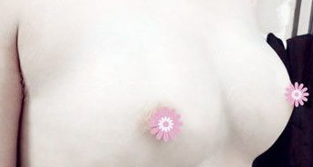 超 声 波自体脂肪丰胸效果展示,大家看好不好! 超 声 波自体脂肪丰胸效果展示,大家看好不好!