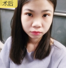 超声 波去眼dài