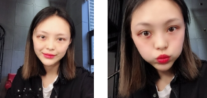 超声 波去眼 袋