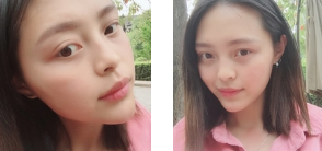 超声 波去眼 袋