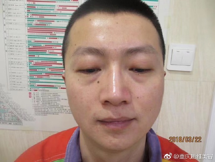 超 声 波去眼袋案例——郑先生得亲身经历 超 声 波去眼袋案例——郑先生得亲身经历