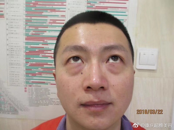 超 声 波去眼袋案例——郑先生得亲身经历 超 声 波去眼袋案例——郑先生得亲身经历