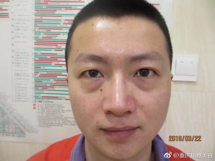 超 声 波去眼袋案例——郑先生得亲身经历 超 声 波去眼袋案例——郑先生得亲身经历