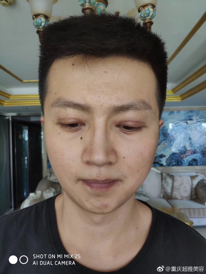 超 声 波去眼袋案例——郑先生得亲身经历 超 声 波去眼袋案例——郑先生得亲身经历