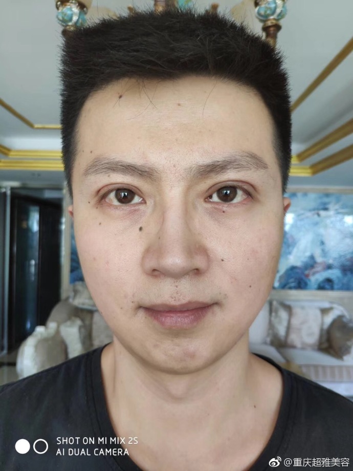 超 声 波去眼袋案例——郑先生得亲身经历 超 声 波去眼袋案例——郑先生得亲身经历