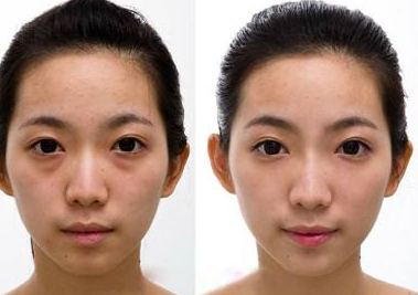 超 声 波去眼袋手术后如果出现皱纹增加能恢复吗? 超 声 波去眼袋手术后如果出现皱纹增加能恢复吗?
