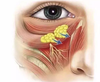 超 声 波去眼袋手术后如果出现皱纹增加能恢复吗？