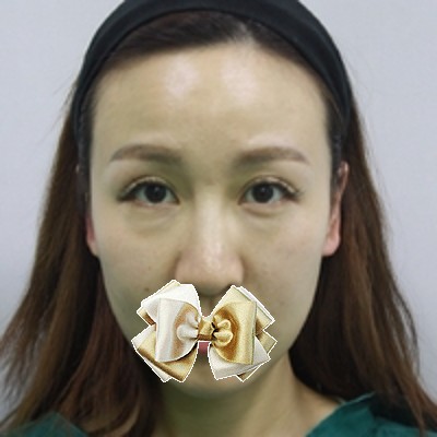 超声波去眼袋,轻松安逸得去除眼袋048 超声波去眼袋,轻松安逸得去除眼袋048