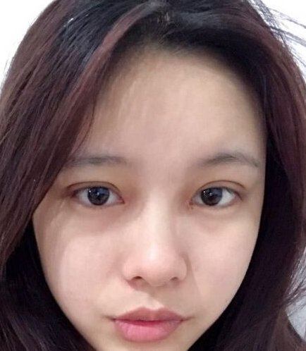 她做完超声波双眼皮后第10天，居然这么自然！323