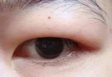 朋友做了双眼皮手术都美美哒,羡慕吧!756 朋友做了双眼皮手术都美美哒,羡慕吧!756
