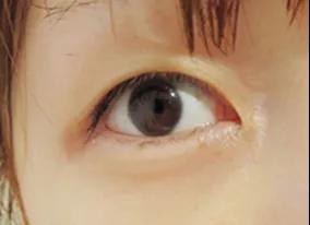 朋友做了双眼皮手术都美美哒,羡慕吧!756 朋友做了双眼皮手术都美美哒,羡慕吧!756