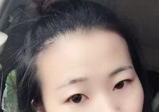 超声波双眼皮30天这么自然?515 超声波双眼皮30天这么自然?515