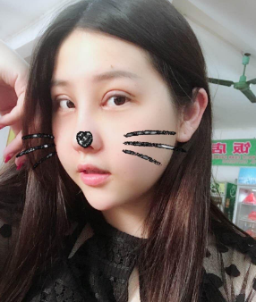 超声波双眼皮30天这么自然?515 超声波双眼皮30天这么自然?515