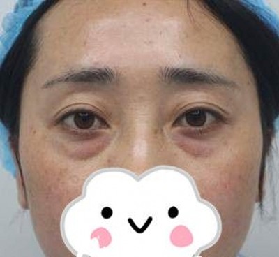 超声波去眼袋让我更加萌萌哒!679 超声波去眼袋让我更加萌萌哒!679