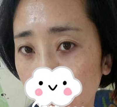 超声波去眼袋让我更加萌萌哒!679 超声波去眼袋让我更加萌萌哒!679