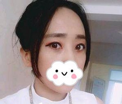 超声波去眼袋让我更加萌萌哒!679 超声波去眼袋让我更加萌萌哒!679