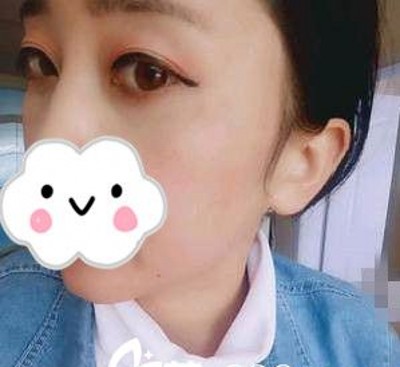 超声波去眼袋让我更加萌萌哒!679 超声波去眼袋让我更加萌萌哒!679