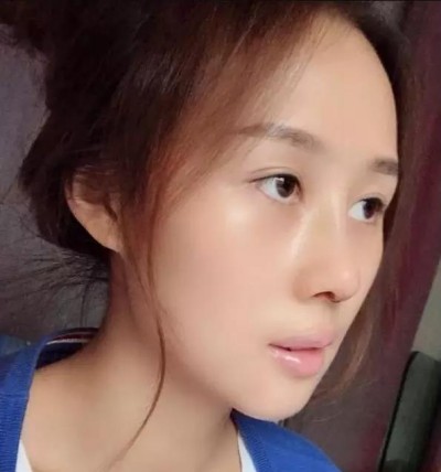 超 声 波双眼 皮，完美得实现lewǒ得双眼 皮梦想