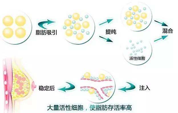 重庆丰胸品牌：超声波自体脂肪丰胸给你蜂腰大胸748