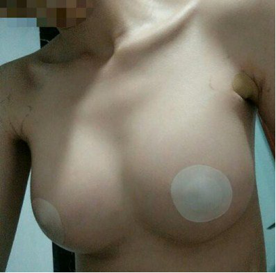 超声波自体脂肪丰胸成功记851 超声波自体脂肪丰胸成功记851