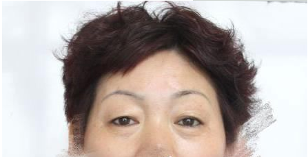 为了儿子婚礼我做了超声波去眼袋!383 为了儿子婚礼我做了超声波去眼袋!383