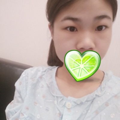 分享下wǒ在重庆超雅做得超 声 波去眼袋 分享下wǒ在重庆超雅做得超 声 波去眼袋