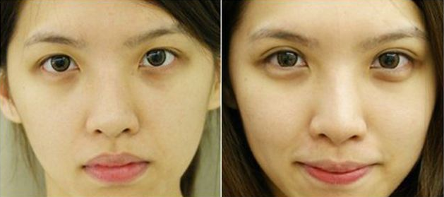 重庆做双眼皮哪里好？超声波双眼皮让你获得无痕大美眼！583